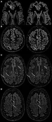 Development of Cortical Lesion Volumes on Double Inversion Recovery MRI in Patients With Relapse-Onset Multiple Sclerosis